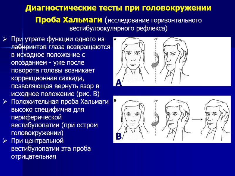 Диагностические тесты при головокружении Проба Хальмаги (исследование горизонтального вестибулоокулярного рефлекса) При утрате функции одного